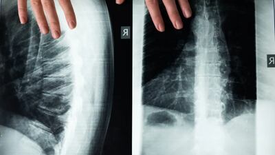 Radiografía revela casi 200 monedas en el estómago de un hombre