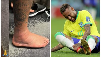 Neymar publica foto de su tobillo y duelo solo de verlo