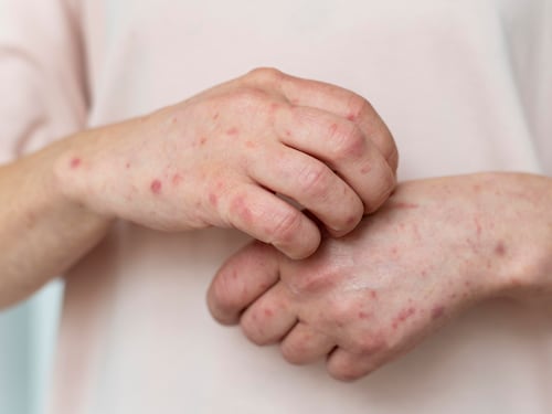 Mineduc activa protocolos por sarampión; pero descartan suspensión general de clases