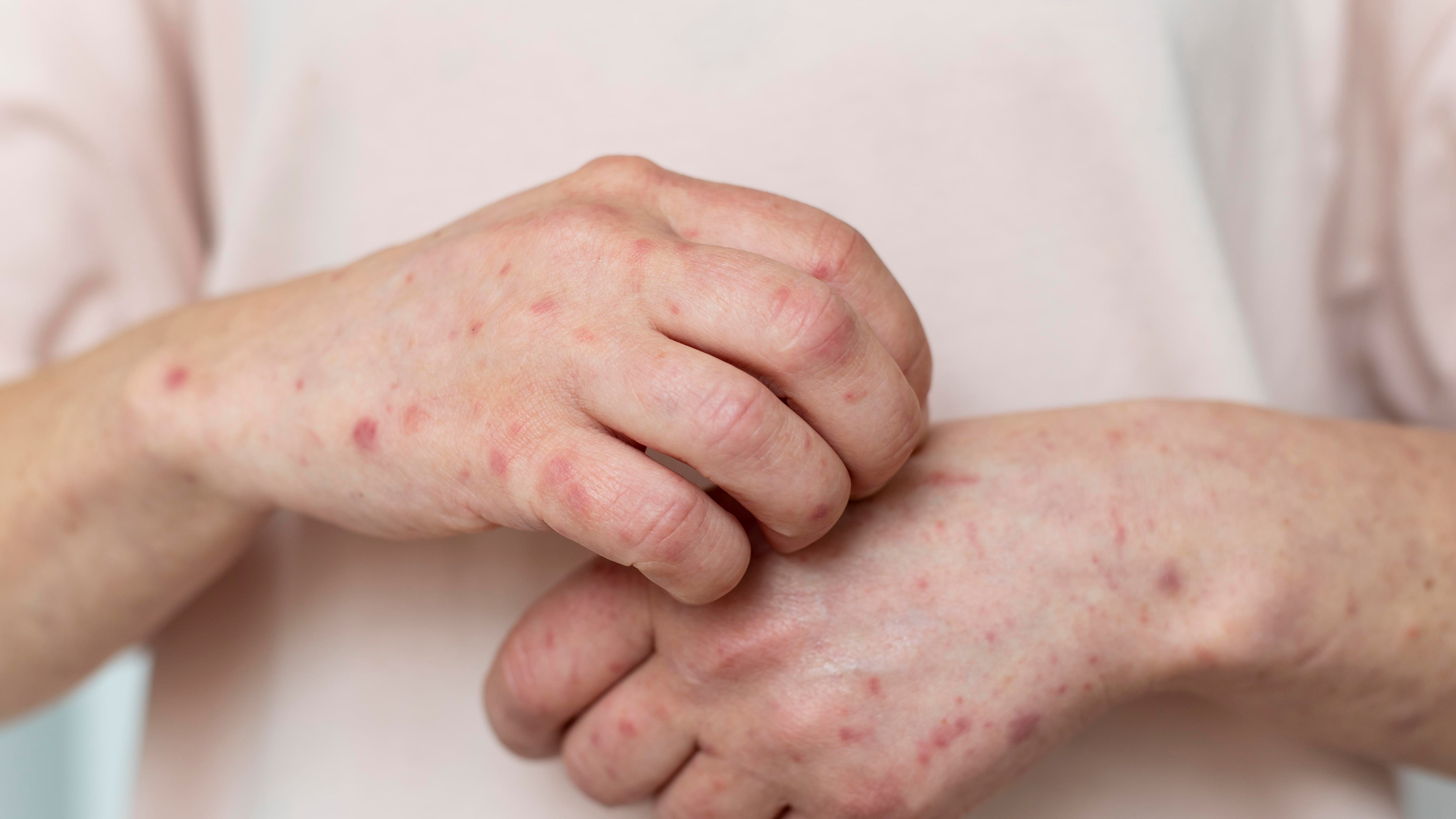 Sarampión en Colombia