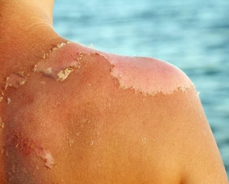 Las enfermedades más comunes en verano que debes evitar
El calor y la humedad pueden jugarte una mala pasada.