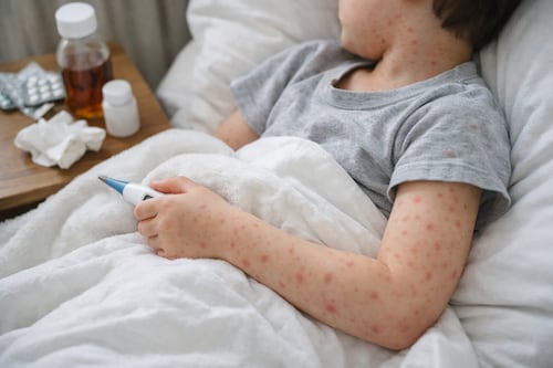 Brote de sarampión: ¿quiénes deben vacunarse?