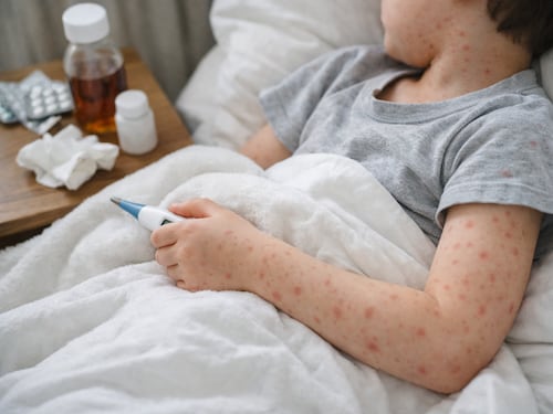 Brote de sarampión: ¿quiénes deben vacunarse?