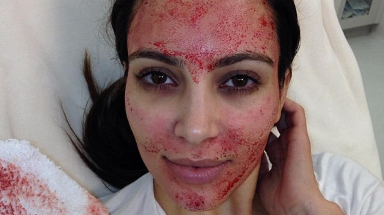 Tres mujeres se contagian de VIH por "facial vampiro" que popularizó Kim Kardashian