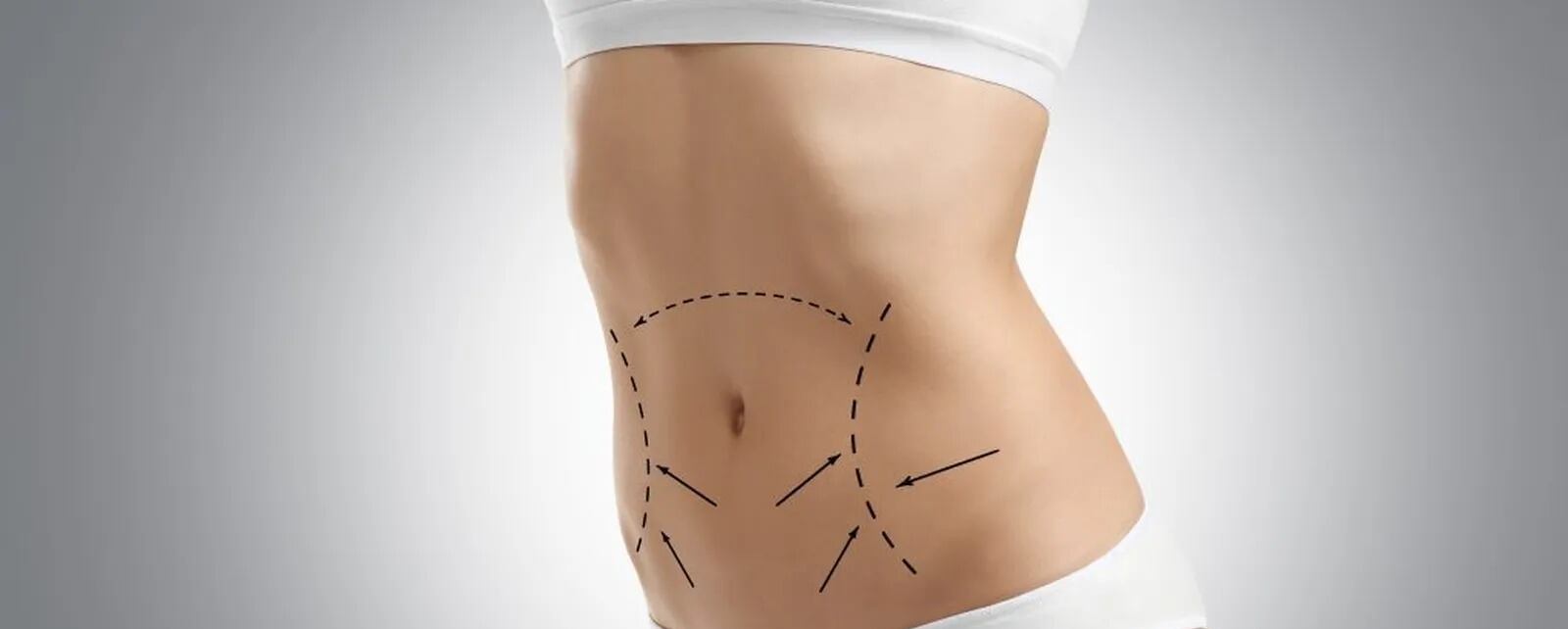 ¿Qué es una liposucción láser y en qué consiste?