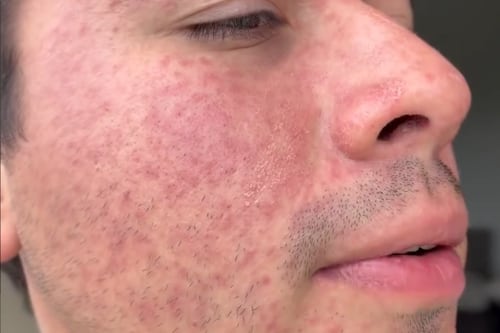 VIDEO. Joshua Aldana exhibe su rostro con Sarampión “Guatemala vacúnense”