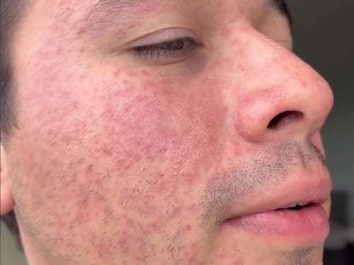 VIDEO. Joshua Aldana exhibe su rostro con Sarampión “Guatemala vacúnense”