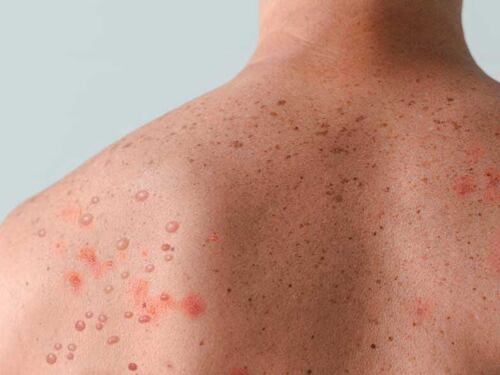 Bolivia declara la emergencia sanitaria tras registrar 60 casos de sarampión en unos dos meses