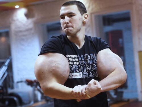 Famoso influencer conocido como ‘Popeye Ruso’ podría perder los brazos tras terrible infección