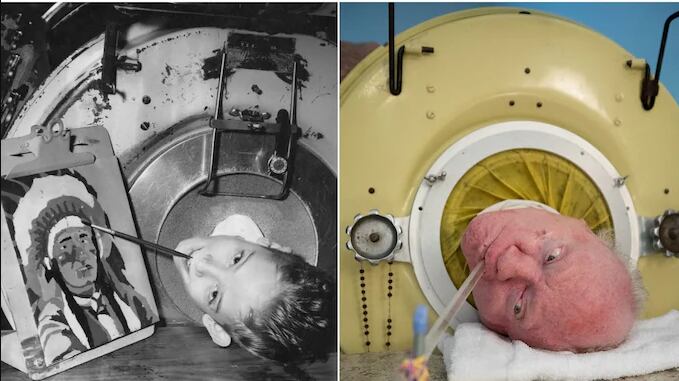¡Superó la polio, pero no este virus! Muerte “Polio Paul” que vivió más siete décadas con un pulmón de acero