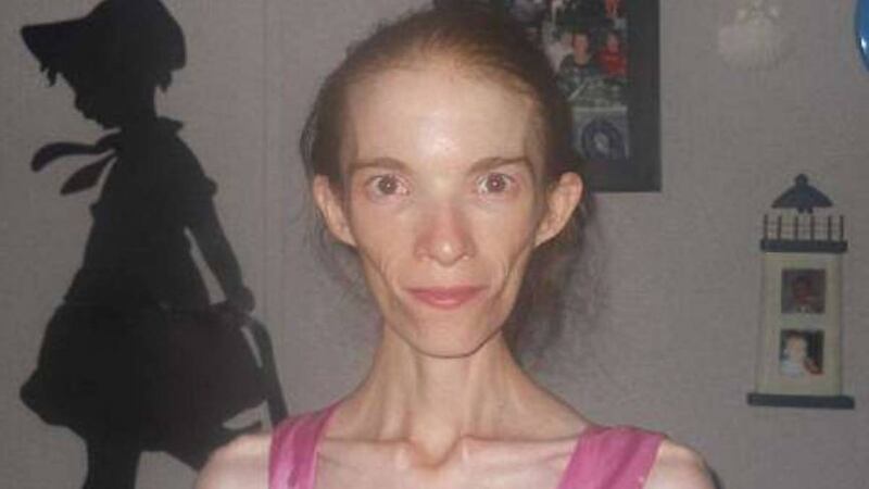 Seguro niega darle tratamiento a mujer con anorexia que solo pesa 26 kilos