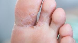 El pie de atleta es una infección fúngica en la piel que, por lo general, comienza entre los dedos de los pies. Foto: Podología Elegancia.