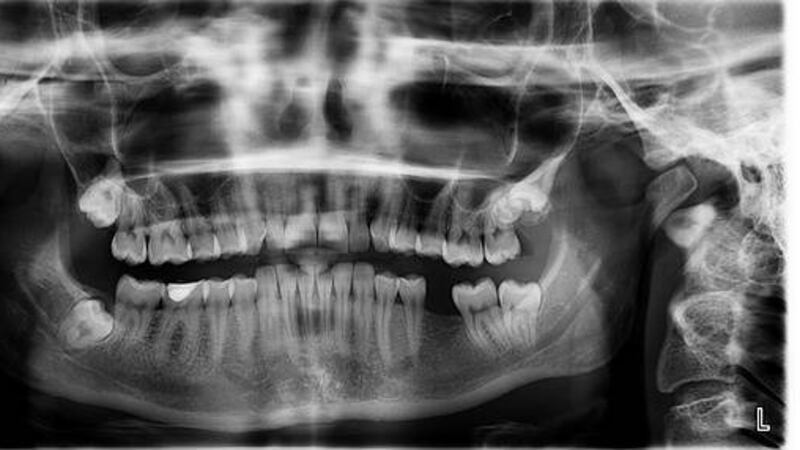 Niño va al hospital por inflamación de mandíbula; le extraen más de 500 dientes