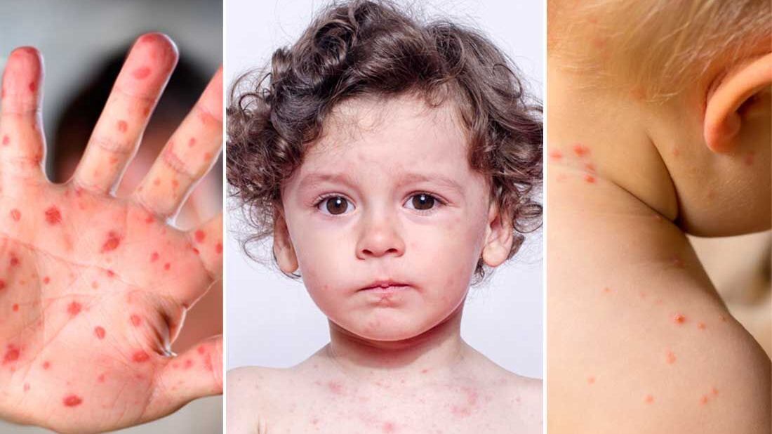 El brote va en aumento: protege a tu familia ahora.