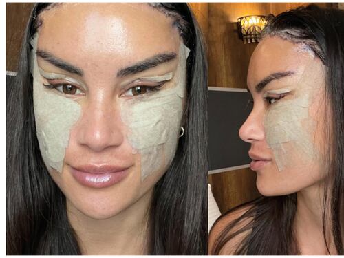 Influencer impacta en redes al mostrar los resultados de una reducción de frente y otras cirugías en su rostro
