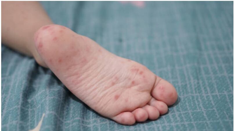 La enfermedad “manos, pies y boca” provoca llagas en la boca y sarpullidos en las manos y los pies.