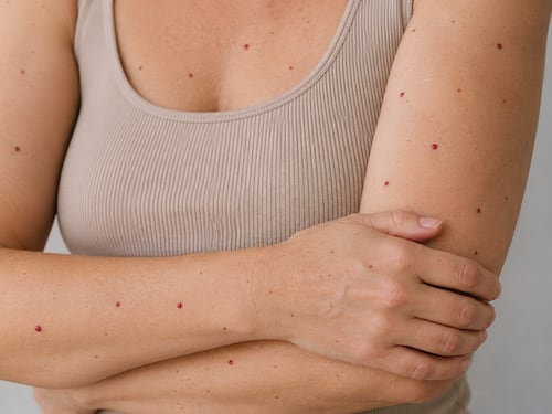 ¿Te aparecieron puntos rojos en la piel? Esto es lo que podrían significar, según expertos