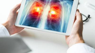 Nuevos estudios reflejan que el cáncer de pulmón vuelve a encabezar lista de muertes en el planeta